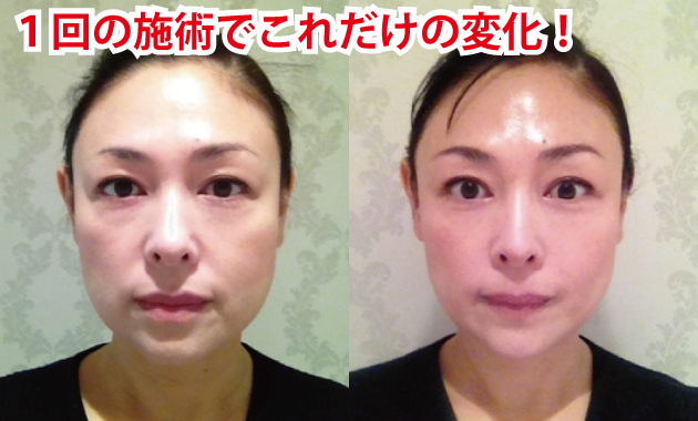 正月むくみの体を張った臨床例♪(土橋ver(笑))