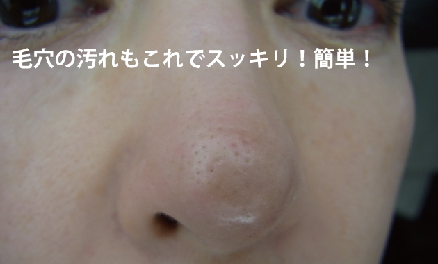 体を張った症例。その2。土橋毛穴編