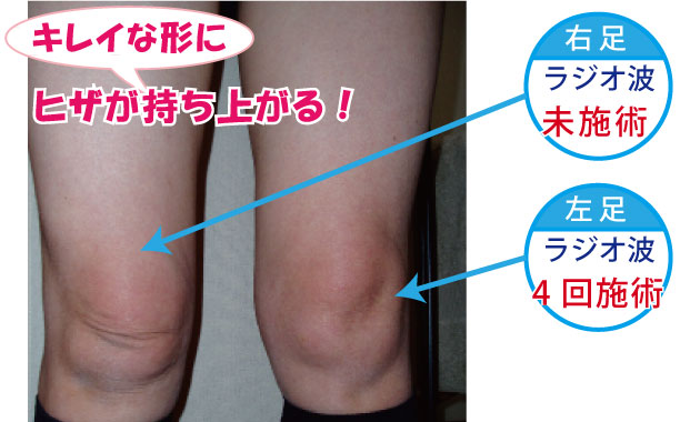 夏が来る前に 第二弾 膝美人 はいかが 藤沢市のエステサロン レイテノール オーナー土橋奈津子ブログ