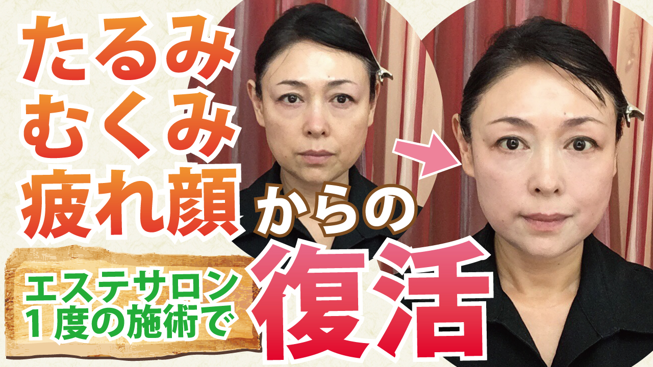 【動画あり】お疲れ顔からの脱却!!レイテノールの真髄*必殺ラジオ波コース